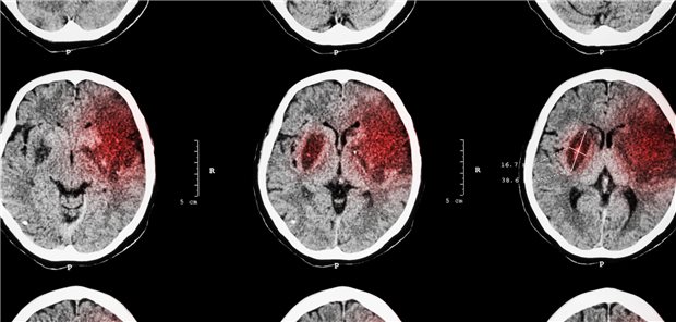 CT des Gehirns eines Patienten mit einem ischämischen Schlaganfall im linken Frontal-, Temporal- und Parietallappen.