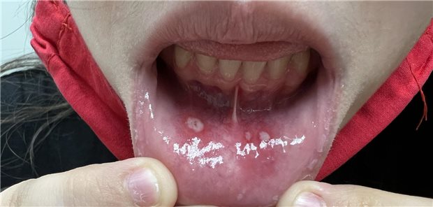 Rezidivierende orale Ulzera sind häufig familiär bedingt. Topische Maßnahmen helfen, heilen diese nicht von selbst ab.