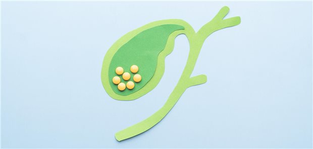 Diagnostik von Gallensteinen: So gehen Sie vor Symbolhafte Darstellung von Gallensteinen