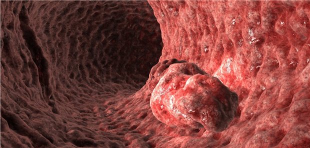 „Koloskopie ist eine Erfolgsgeschichte“ Sind die Polypen im Darm gut- oder bösartig? Digitale Technologien können dies bald in Echtzeit vorhersagen.