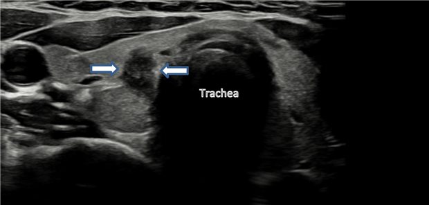 Sonographie mit papillärem Schilddrüsenkarzinom im rechten Schilddrüsenlappen (Querschnitt) mit Echoarmut, unscharfer Begrenzung und taller-than-wide-Zeichen.