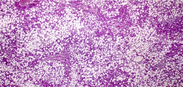 Fettleber-Erkrankungen nehmen zu bei Patienten mit HIV Dreidimensionale gerenderte Illustration des Röntgenhologramms einer menschlichen Leber.