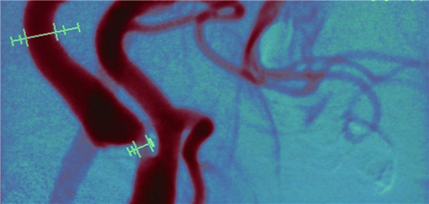 Stumme Karotisstenose: Lohnt sich die Revaskularisation? Stenose der Karotis