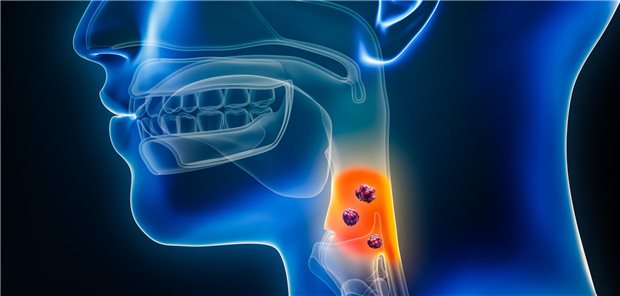 Kopf-Hals-Tumoren: Welche Therapie schont die Speicheldrüsen? Symbolbild