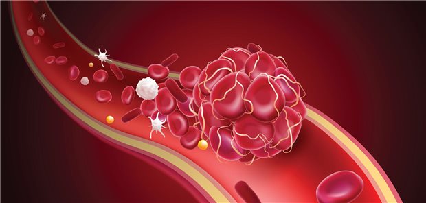 Ein Thrombus in einem Blutgefäß
