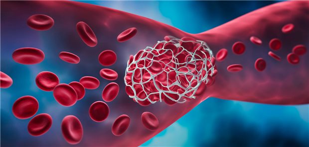 Thrombus im Gehirn: Auch Patienten mit relativ spätem Lysebeginn können von einer Thrombolyse profitieren, wenn rettbares Hirngewebe nachweisbar ist.