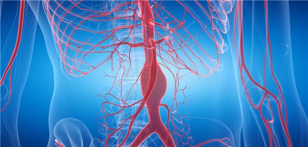 3d gerenderte, medizinisch genaue Darstellung eines Aneurysmas im Bauchraum