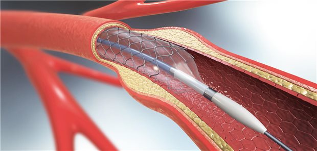 Vorhofflimmern plus Stent: Auf Dauer bitte keinen Plättchenhemmer! Ein Stent in einem Gefäß