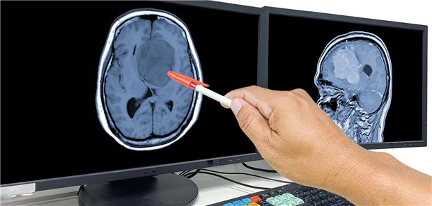 Unterschiedliche immuntherapeutische Ansätze beim Glioblastom werden derzeit in Studien untersucht. Ein Teilgebiet ist die Peptidvakzinierung, also die Impfung mit Tumorantigenen.