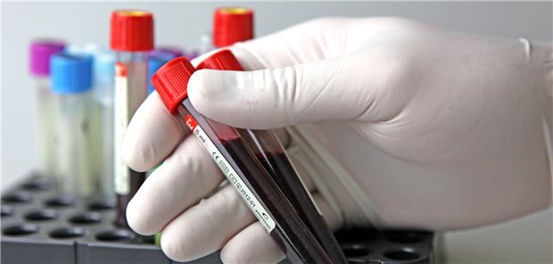 HIV-Patienten: Neue Studien zu Mpox, STI und PrEP Untersuchung von Blutproben, etwa auf Mpox und STI – das waren zwei der Themen, die bei der CROI und beim DÖAK diskutiert wurden.