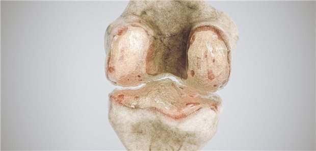 Veränderung der Knorpel- und Knochenstruktur mit Schmerzen und eingeschränkter Gelenkfunktion: Zur Therapie der Gonarthrose veröffentlicht die Deutsche Gesellschaft für Orthopädie und Unfallchirurgie im Juni 2025 eine S3-Leitlinie. (Symbolbild)