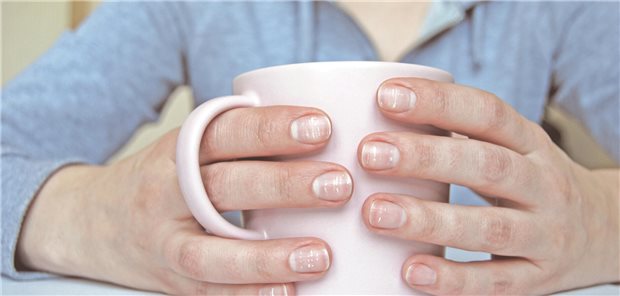 Fingernägel einer Frau mit Leukonychie, die man an der opaken weißen Verfärbung der Nägel erkennen kann.