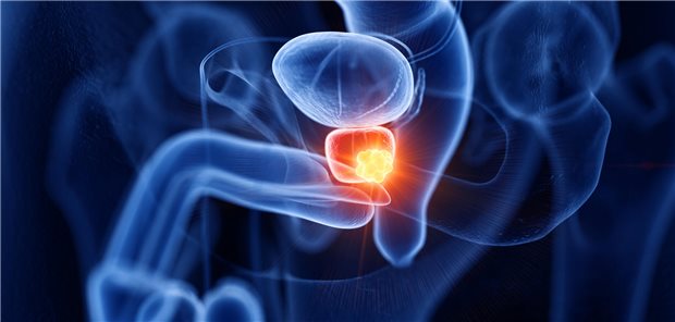 3D-Darstellung eines männlichen Unterleibs mit einem Tumor in der Prostata.