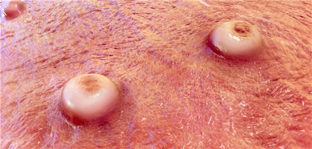 Der Mpox-Hautausschlag in Großaufnahme.