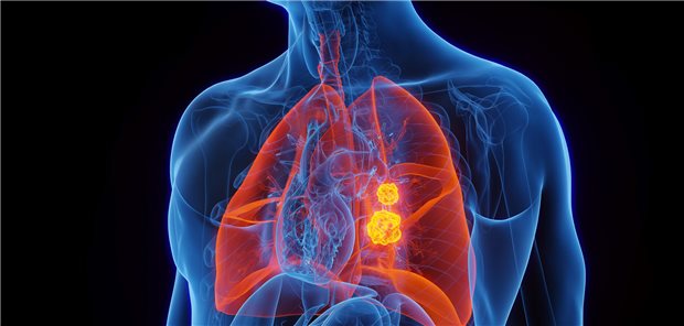 Lungenkrebs dargestellt