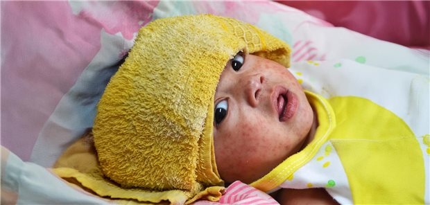 WHO: Gefahr durch Masern steigt - Warnung vor Impflücken Während fast alle Kinder in Deustchland eine Erst-Impfung gegen Masern erhalten, erfolgt die zweite - wenn überhaupt - häufig erst nach dem zweiten Lebensjahr.