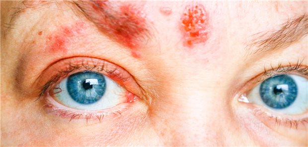 Ausschlag im Gesicht und um das Auge herum aufgrund von einer Erkrankung an Herpes zoster ophthalmicus.