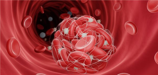 Krebserkrankung: So könnte die Thromboseprophylaxe noch besser werden Modell einer venösen Thromboembolie.
