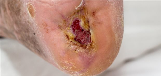 offene Wunde an der Ferse