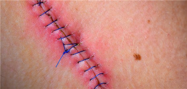 Eine genähte Wunde