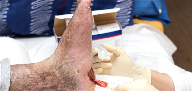 Wundversorgung am diabetischen Fuß: Wenn eine mindestens zweiwöchige Behandlung mit Verbandmitteln erfolglos geblieben ist, kann nun erstmals dauerhaft ein „sonstiges Produkt zur Wundbehandlung“ eingesetzt werden – auch nach der Übergangsfrist, die im Dezember 2025 ausläuft.