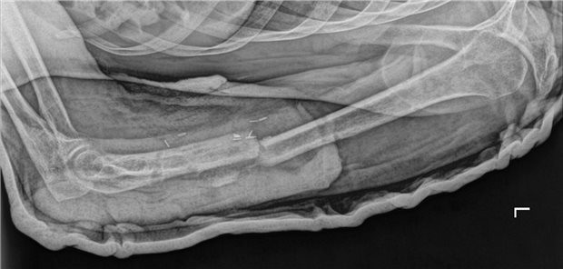 Röntgenbild einer Humerusfraktur mit Verschiebung.